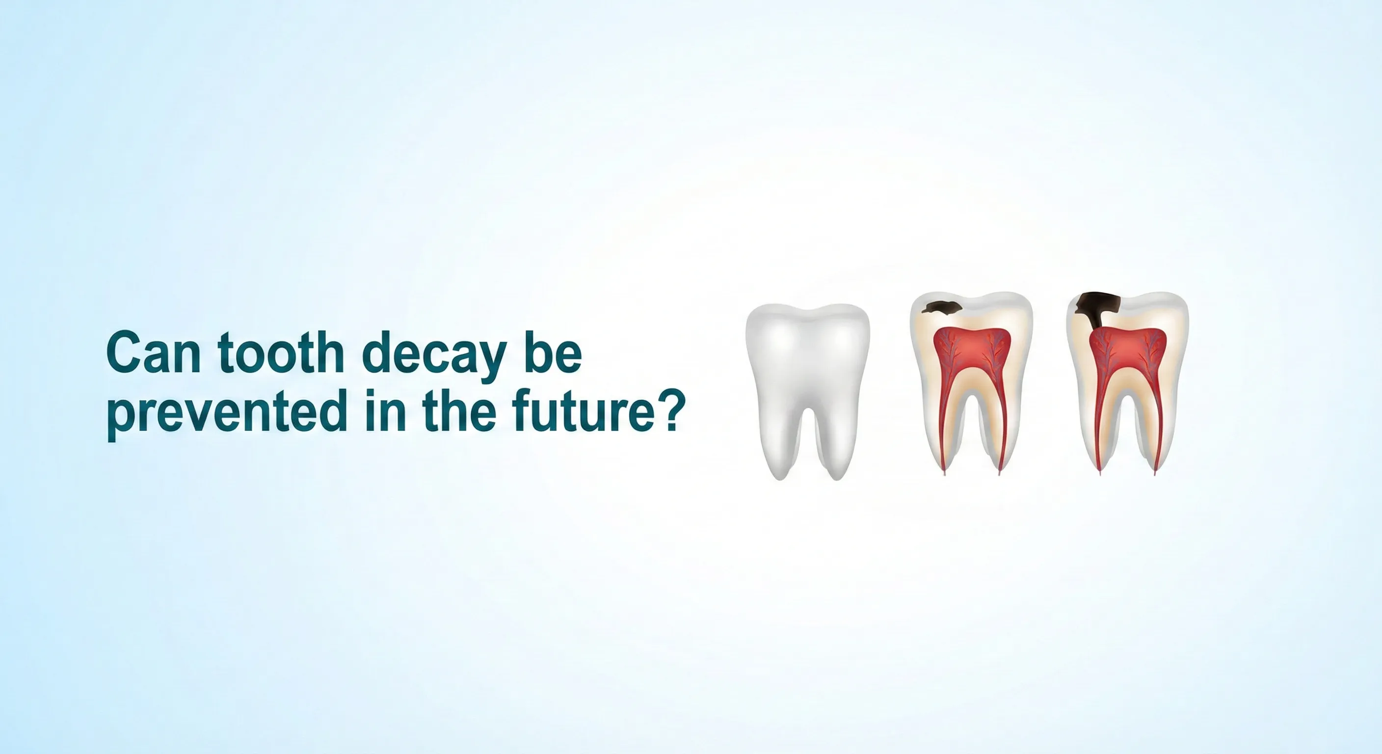 Caries Vaccine: Can Tooth Decay Be Prevented in the Future?