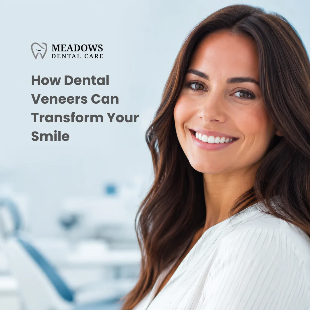 How Dental Veneers Can Transform Your Smile