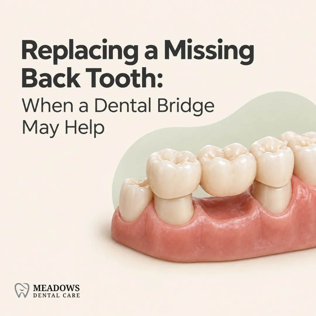 Replacing a Missing Back Tooth: When a Dental Bridge May Help