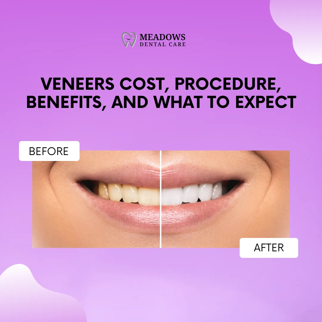Veneers Cost, Procedure, Benefits, and What to Expect