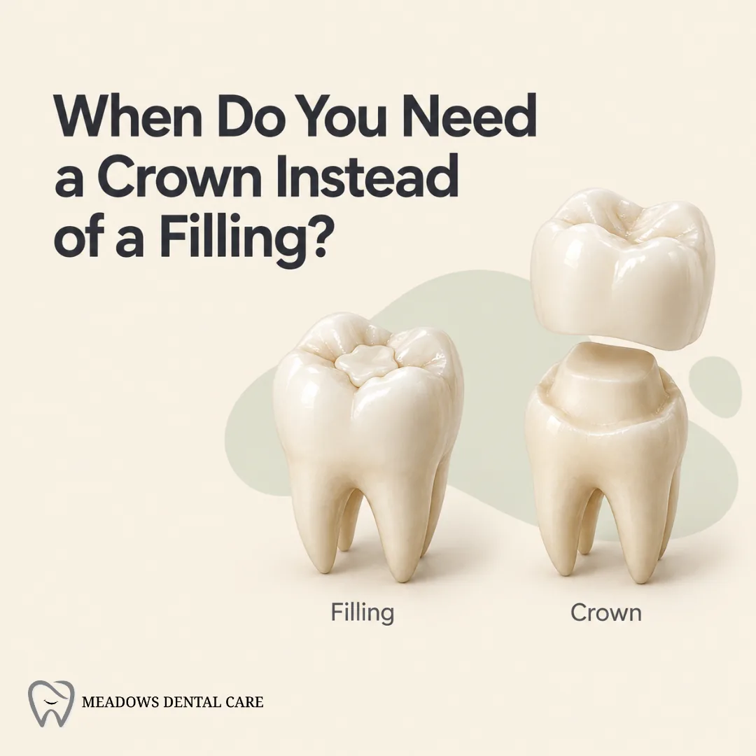 When Do You Need a Crown Instead of a Filling?
