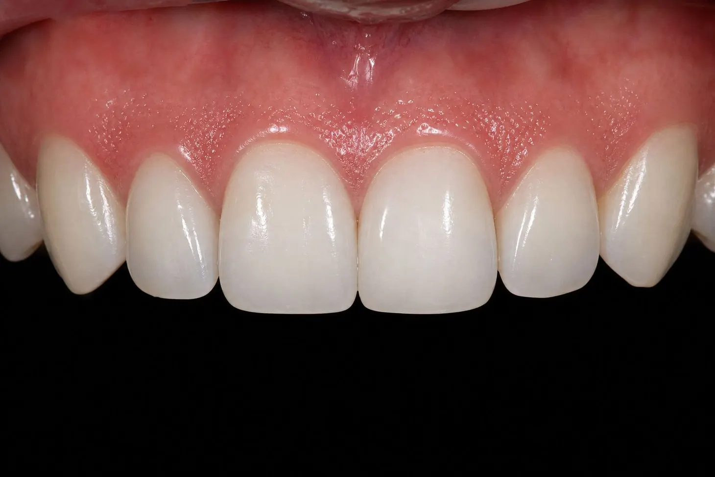 Front Tooth Restoration — after treatment