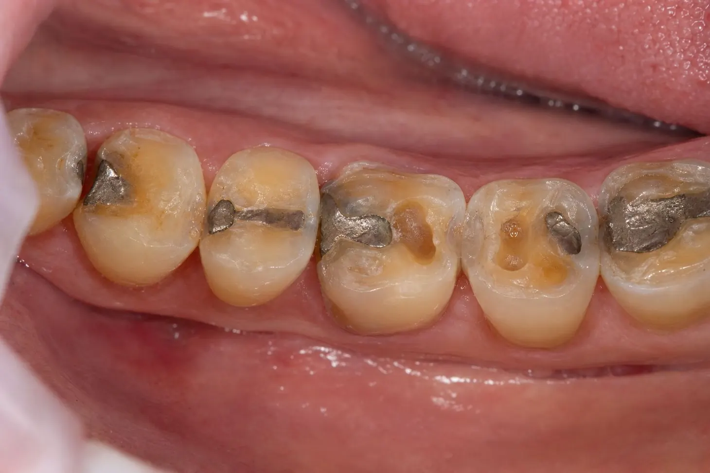 Functional Restoration — before treatment